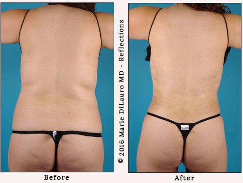 liposuction to stomach-waist-butt